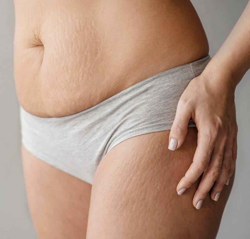 Smoothing the Path: How CBD Roll-Ons Can Help Reduce the Appearance of Stretch Marks